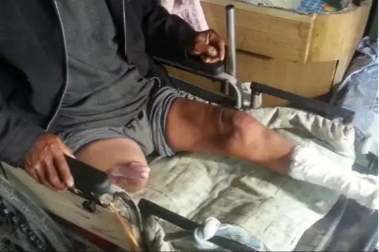 河北男子拿不出100万手术费,回家自己锯掉双腿,12年过去怎样了